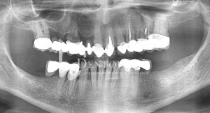 Bilateral functional rehabilitation with implants - Mandibular implant supported bridges - Dentoplant case