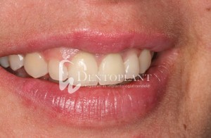 Smile makeover! IPS e.max aesthetic pressed ceramic crowns and modifying the gingival contour with parodontal microsurgery.