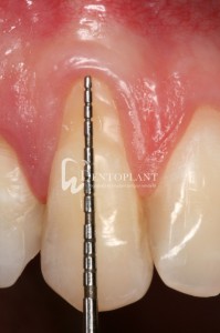 Oral hygiene cleaning and evaluation - Dentoplant case