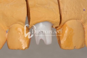 dentoplant-case-3-8-1024x682