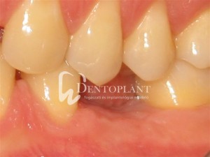 Implant-supported molar - before - Dentoplant case