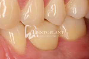 Implant-supported molar - after - Dentoplant case