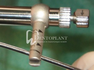 dentoplant-case-4-5-1024x768