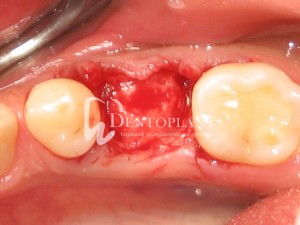 Alveolar socket preservation - After extraction - Dentoplant case