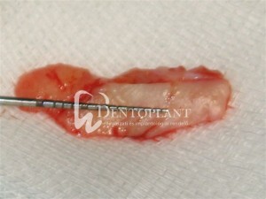 Alveolar socket preservation - Free palatal connective tissue graft - Dentoplant case