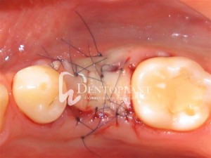Alveolar socket preservation - The free connective tissue graft is used to close the extraction site with microsurgical sutures - Dentoplant case