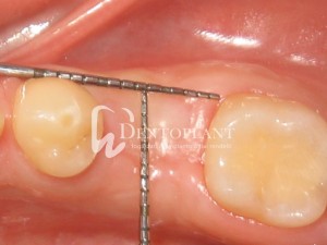 Alveolar socket preservation - Assessment - Dentoplant case