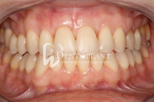 Shifted central incisor due to severe periodontal disease - Achieved outcome - Dentoplant case