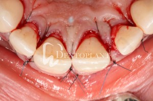 Shifted central incisor due to severe periodontal disease - Sutures - Dentoplant case