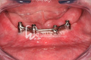 Treatment of edentulousness with implants - Four mandibular implants and a screw retained bar for a lower overdenture - Dentoplant case