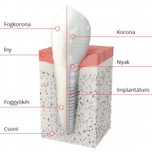 Implantology at Dentoplant Clinic