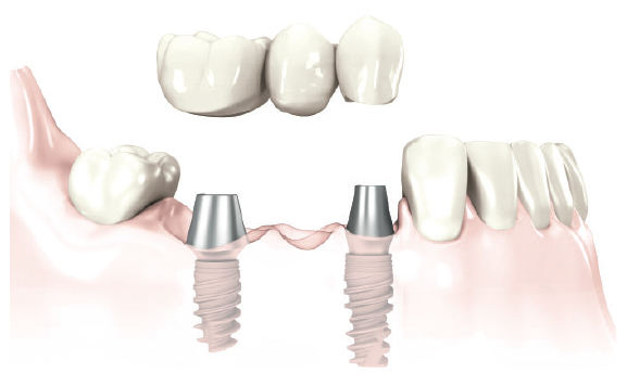 Implantology at Dentoplant Clinic