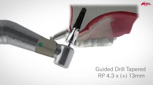 Implantology at Dentoplant Clinic - Phase 2: Placing the screw into the jaw bone