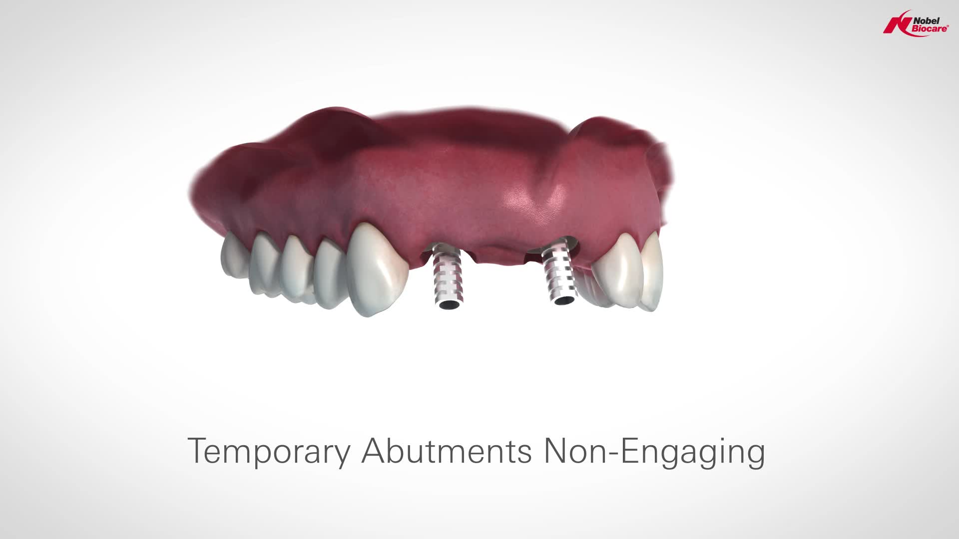 Implantology at Dentoplant Clinic - Phase 4: Shaping the gum and taking impressions