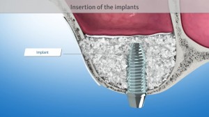Cross-sectional view of the implant stabilised with bone substitute