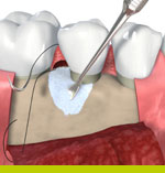 Periodontal treatment - Dentoplant Clinic