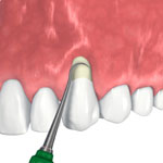 Periodontal treatment - Dentoplant Clinic