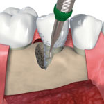 Periodontal treatment - Cleaning the root surface