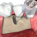 Periodontal treatment - Conditioning the root surface