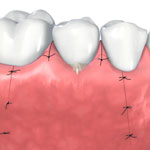 Periodontal treatment - Closing the wound