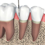 Periodontal treatment - After healing