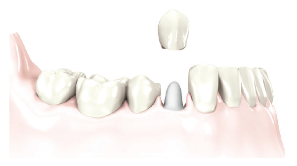 Replacement of a severely damaged crown without missing teeth