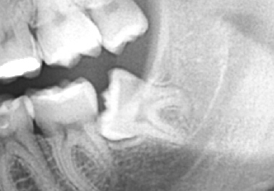 Impacted wisdom tooth X-ray at Dentoplant Clinic