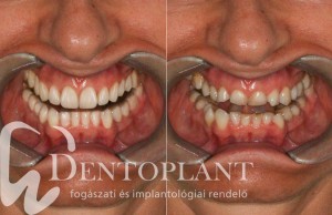 Dentoplant Szeged fogászat smile design