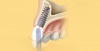 Dentoplant Nobel implantátum Szeged2
