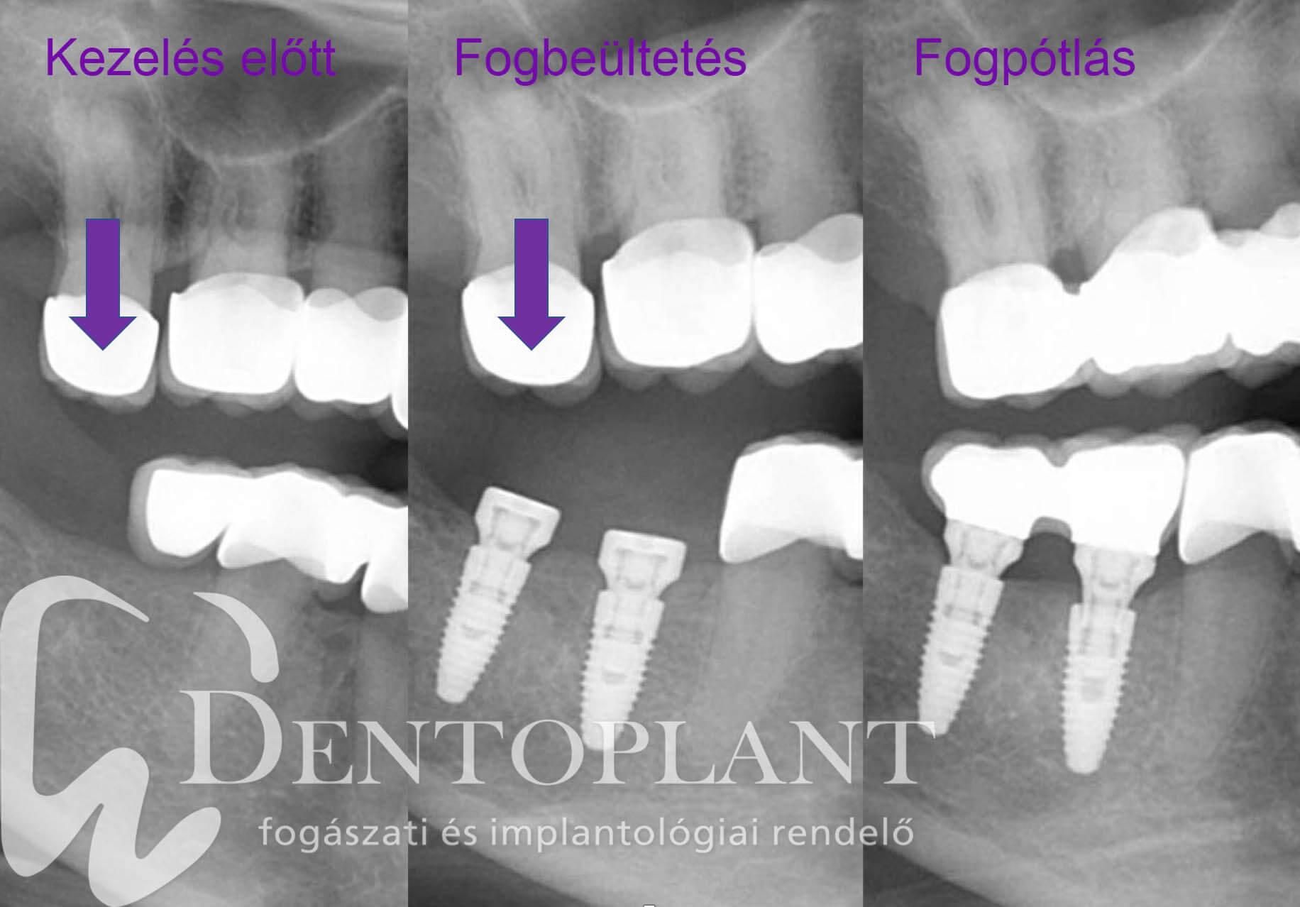 01- Dentoplant fogbeültetés Nobelbiocare On1 Dr. Maráz Kinga
