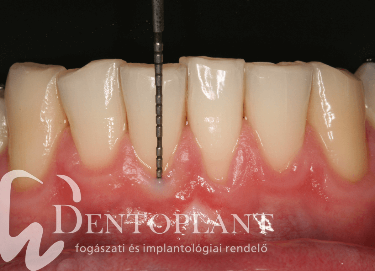 cukorbetegség 1 típusú fogak kezelésére