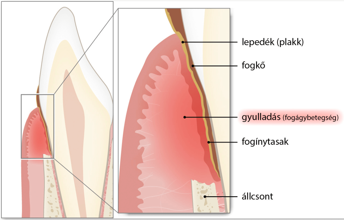 1. Fogágybetegség Dentoplant Szeged fogorvos_05
