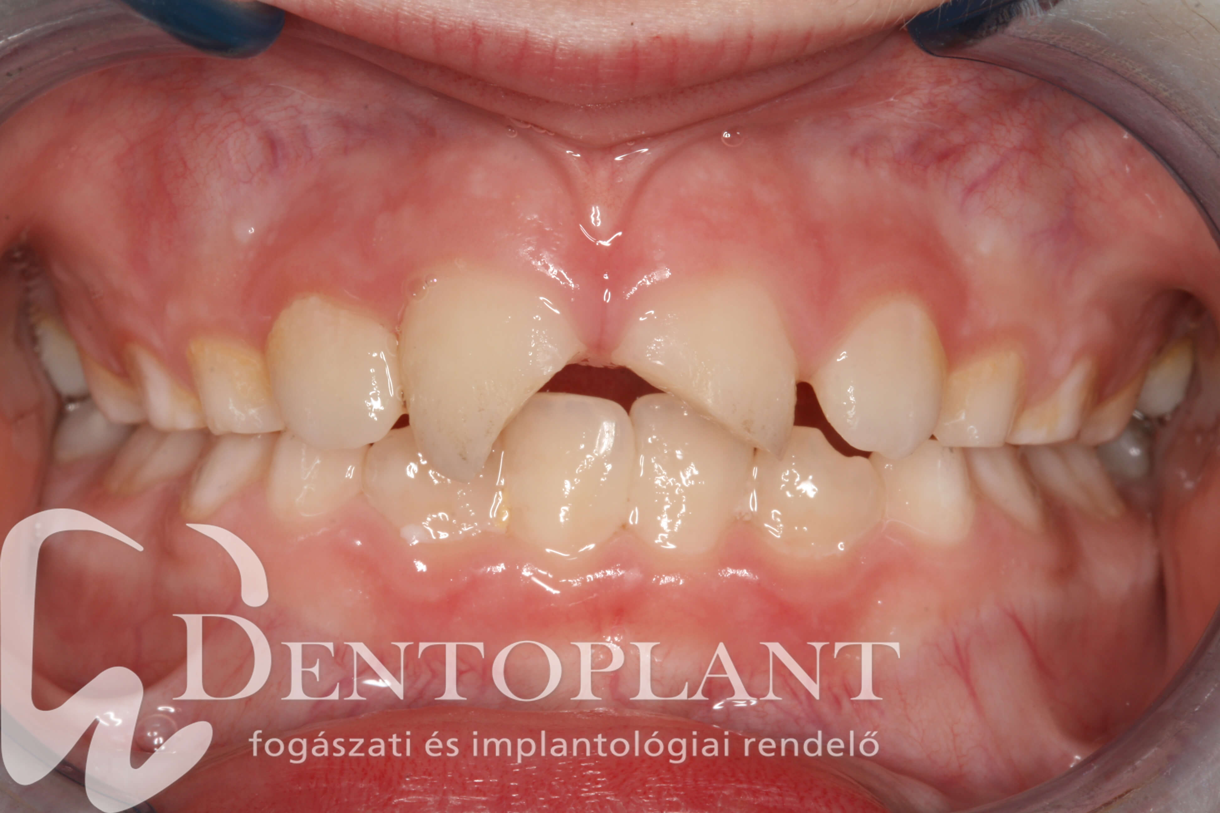 Dentoplant fog trauma fogászat Szeged_03