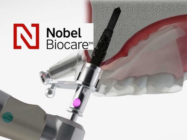 4. Nobel implantatum beültetes Dentoplant másolat