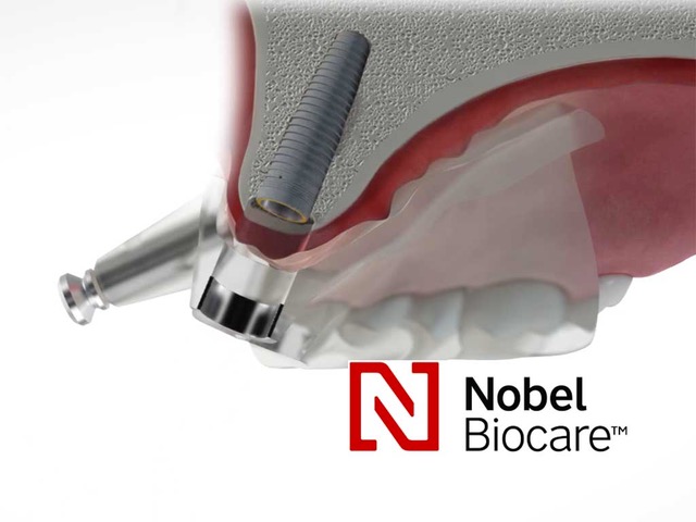 5. Nobel implantatum