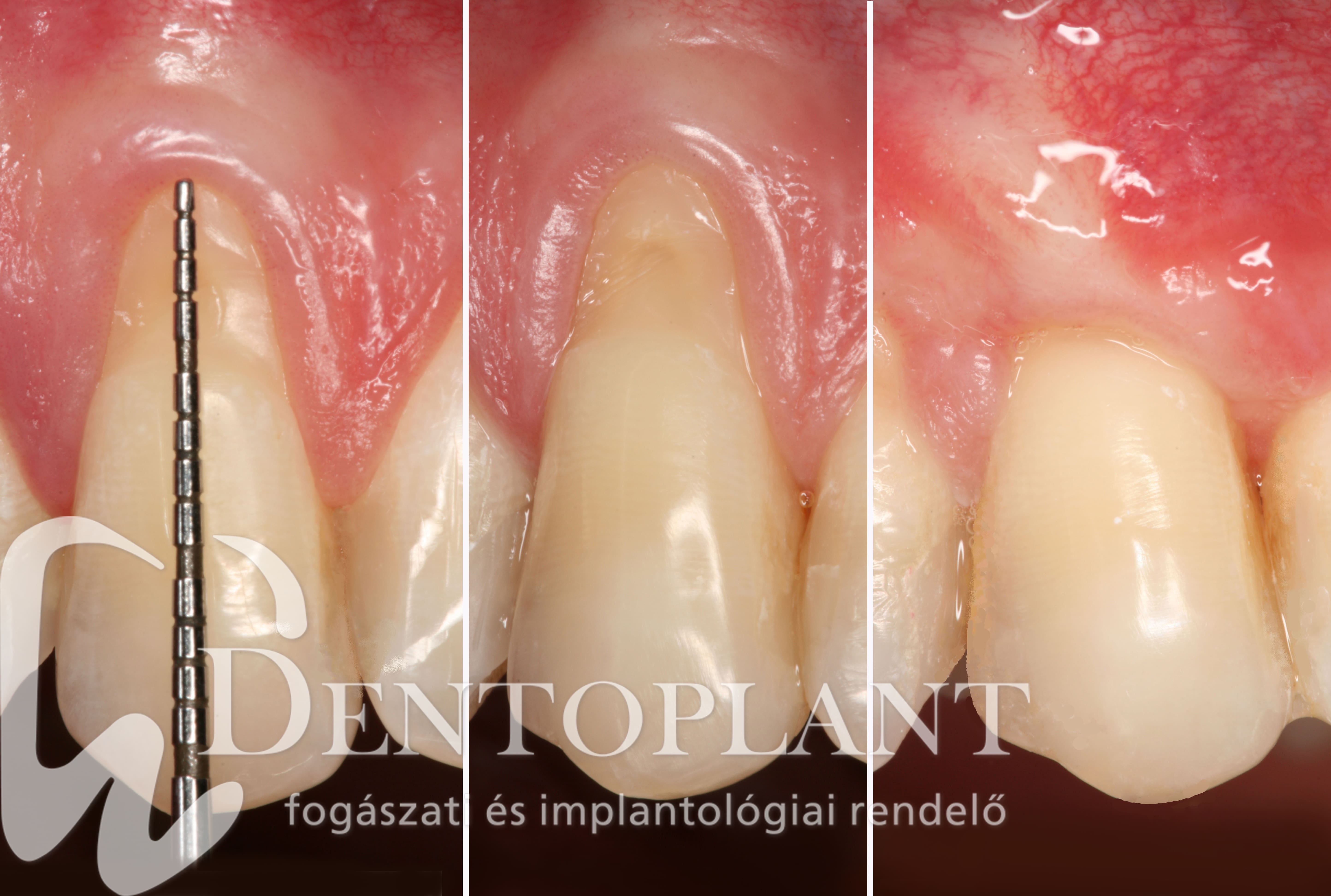 2. Dentoplant Ínyrecesszió fogágy plasztikai sebészeti-min