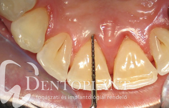4. Dentoplant fogágybetegség kezelése