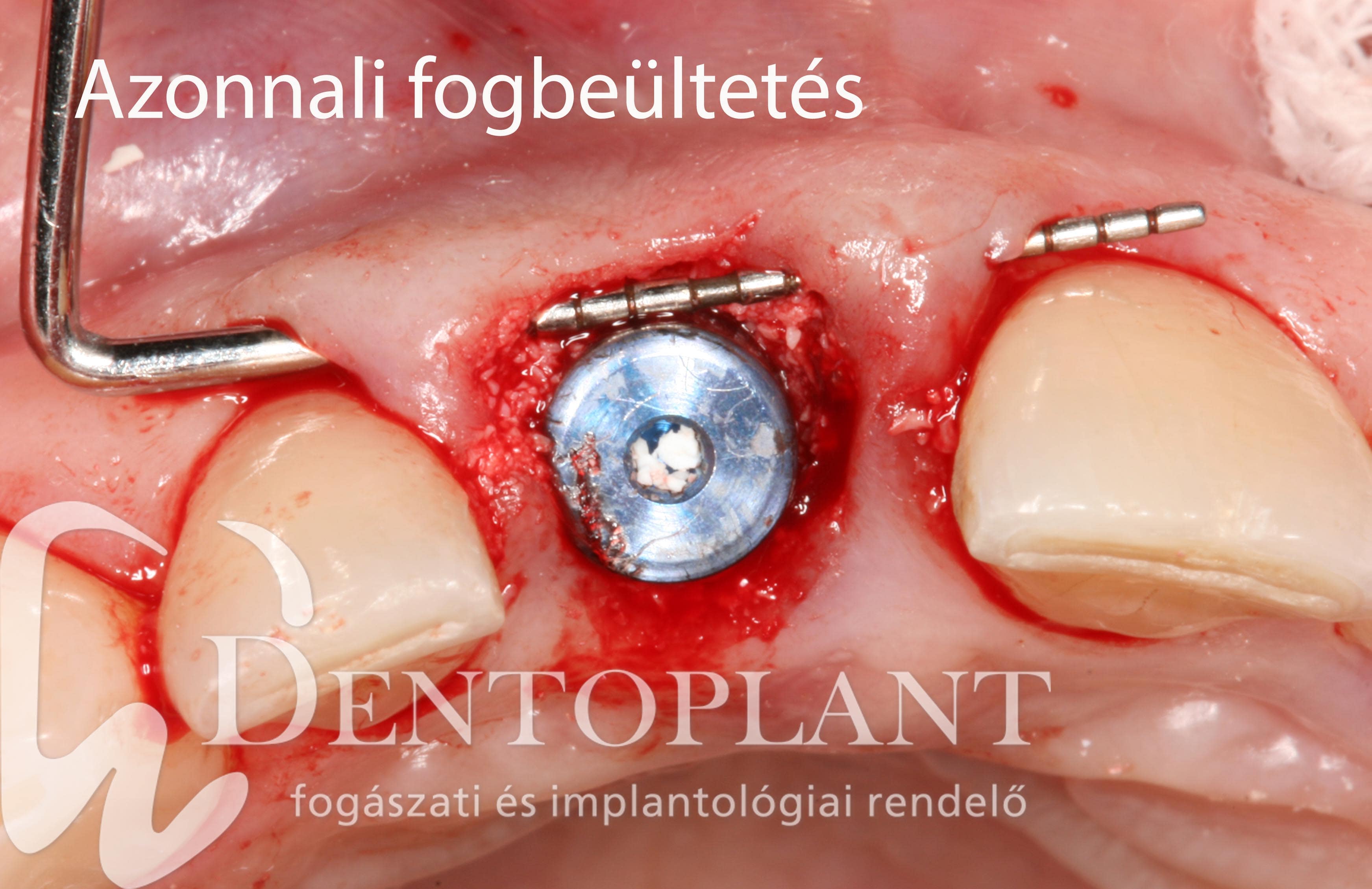 3. Azonnali iplantáció dentoplant-min
