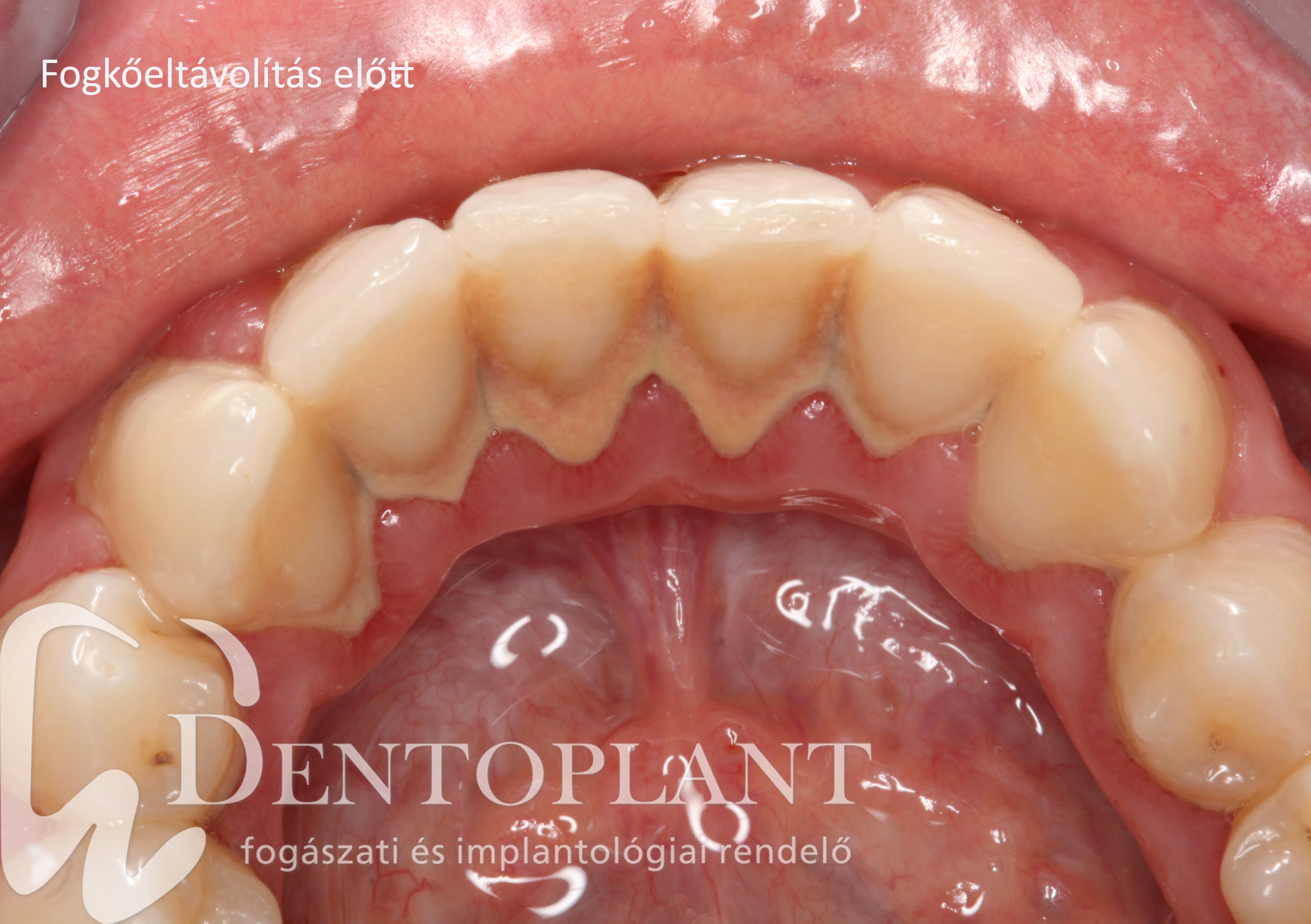 4. Dentoplant fogkő fogászat szeged-min