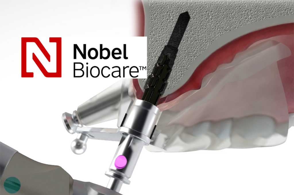3. Dentoplant  implantáció Nobelbiocare jpg-min